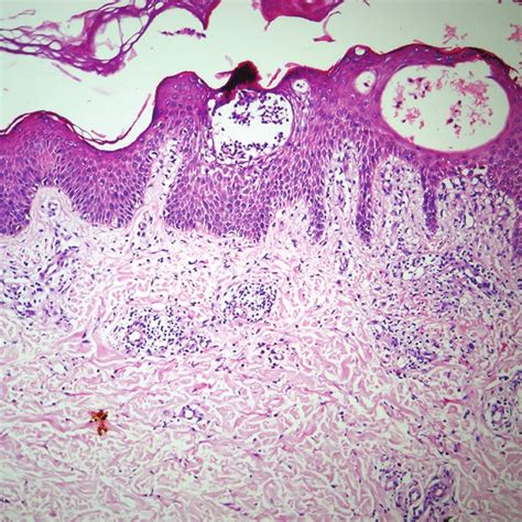 Features of spongiotic dermatitis (H and E, ×40) Figure 1: Vesicles... | Download Scientific Diagram