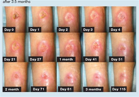 Figure 3 from Healing of an arterial leg ulcer by compression bandaging ...