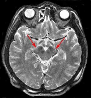 Brain and Spines: Parkinson's Disease