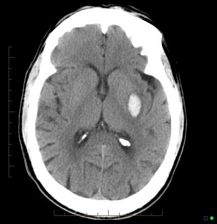 Basal Ganglia Hemorrhagic Stroke