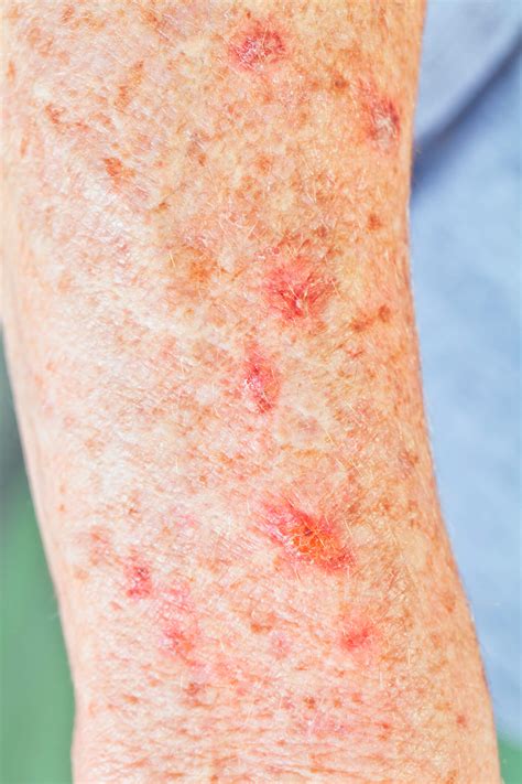 Actinic Keratosis – ResearchTrials.org