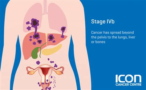 Cervical Cancer — Icon Cancer Centre Singapore