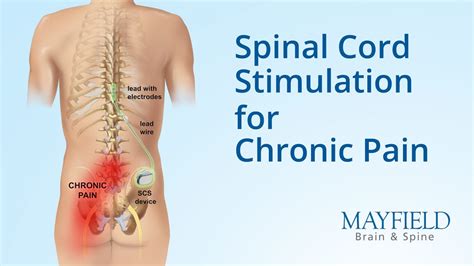 Abbott Spinal Cord Stimulation