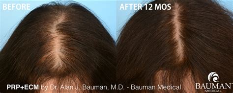 PRP Hair Regrowth Results in Female Patient · Bauman Medical