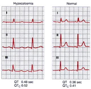 Hypocalcemia And Ecg Changes