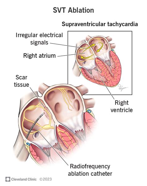 SVT Ablation