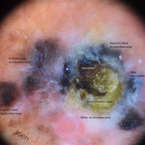 Histopathologic images of spindle cell melanoma. (a) Irregular... | Download Scientific Diagram