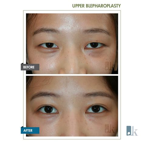 Asian Double Eyelid Surgery - John Kang MD F.A.C.S :: JK Facial Plastics & Reconstructive