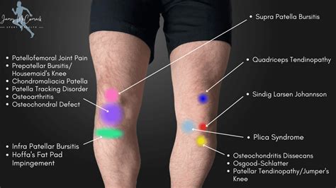 Knee Pain Location Chart Learn The Pain Location Of Knee Injuries | sexiezpix Web Porn