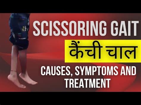 कैँची चाल ! scissor gait explained in hindi ! causes & treatment of scissoring gait ! cp ...