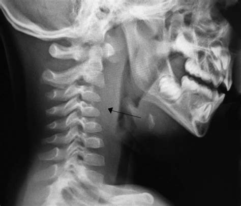 Tonsillitis - Quinsy - Abscess - Antibiotics - TeachMeSurgeryTeachMeSurgery