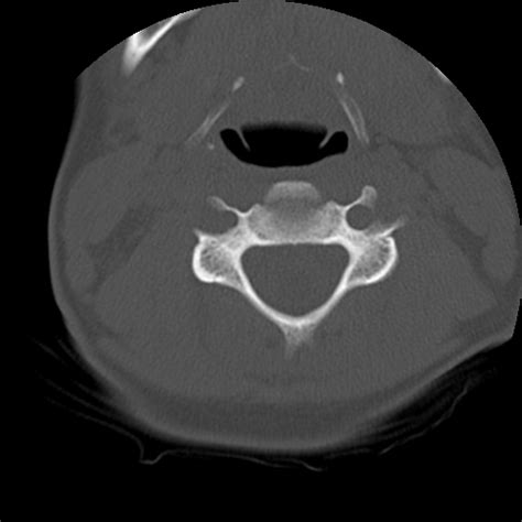 Cervical syrinx with atlanto-axial assimilation | Image | Radiopaedia.org