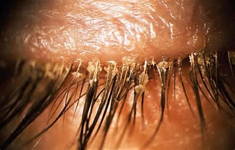 Demodex Infestation of the Eyelashes - Coral Springs Eye Doctor | Vision World