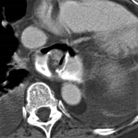 Fundoplication Complications | Radiology Key