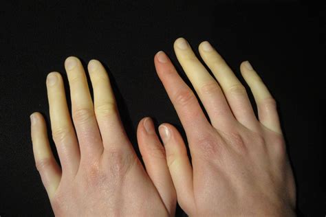 Symptoms of Raynaud's Disease