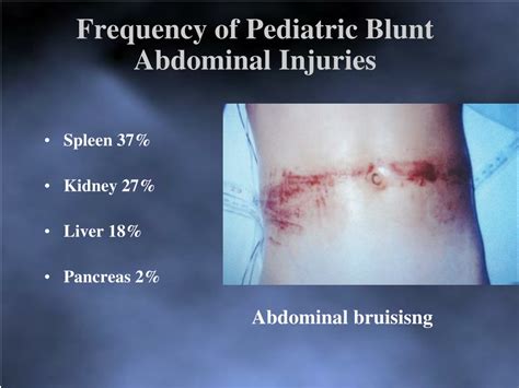 PPT - Management of Blunt and Penetrating Abdominal Trauma in Children PowerPoint Presentation ...