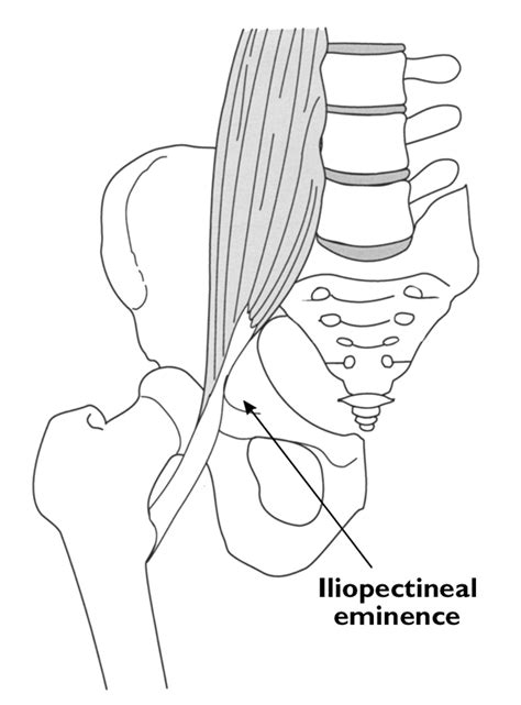 Iliopectineal Eminence