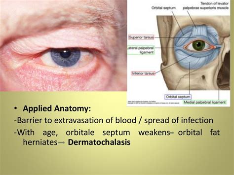 Anatomy of Eyelids & Its Clinical Correlations