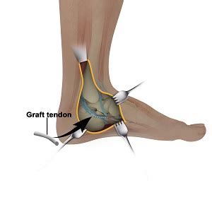 Posterior Tibialis Tendon Repair Kansas City | Posterior Tibialis Tendon Injury Lee’s Summit