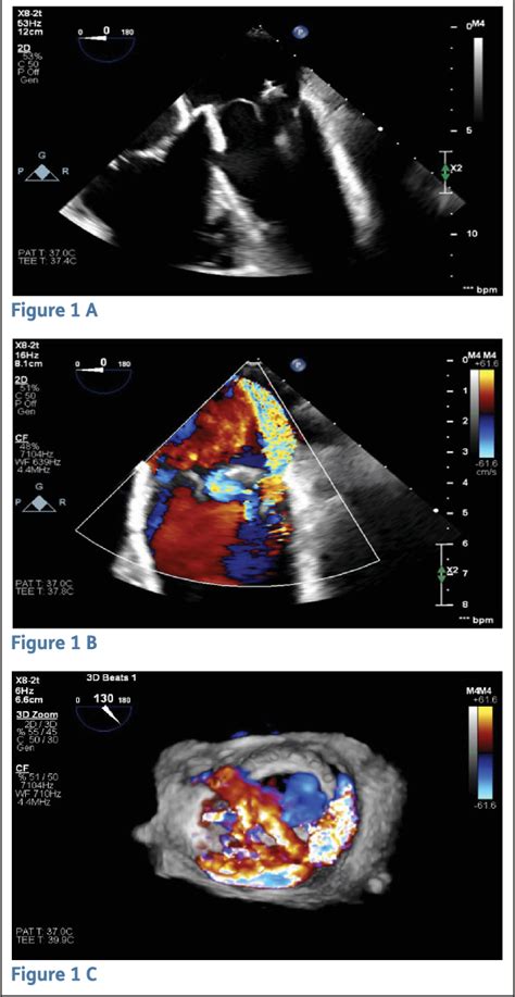 Figure 1 from Percutaneous Management of Bioprosthetic Mitral Valve Dehiscence with Combined ...