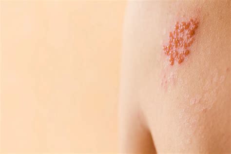 Shingles Symptoms & Treatment - Schweiger Dermatology Group