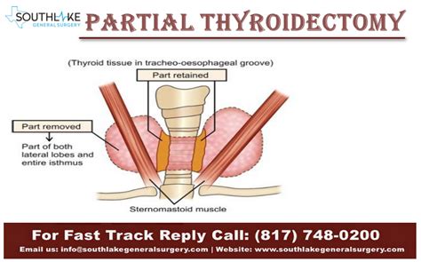 Partial Thyroid Removal Surgery and Recovery - Southlake General Surgery