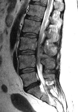 Spinal Epidural Abscess: Background, Pathophysiology, Epidemiology