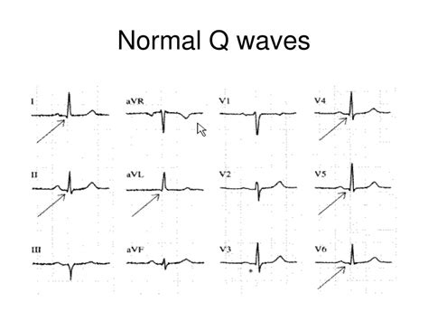 PPT - EKG 101 PowerPoint Presentation, free download - ID:3221620