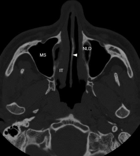 Maxillary Sinus: Normal Anatomy & Variants