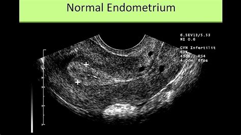 Thickness Of Uterine Lining After Menopause - Menopause Choices