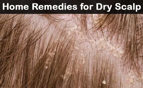 Fast-Acting Dry Scalp Treatments: 31 Natural Home Remedies