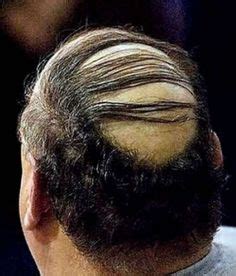 16 Comb overs ideas | comb over, bad hair, bald men