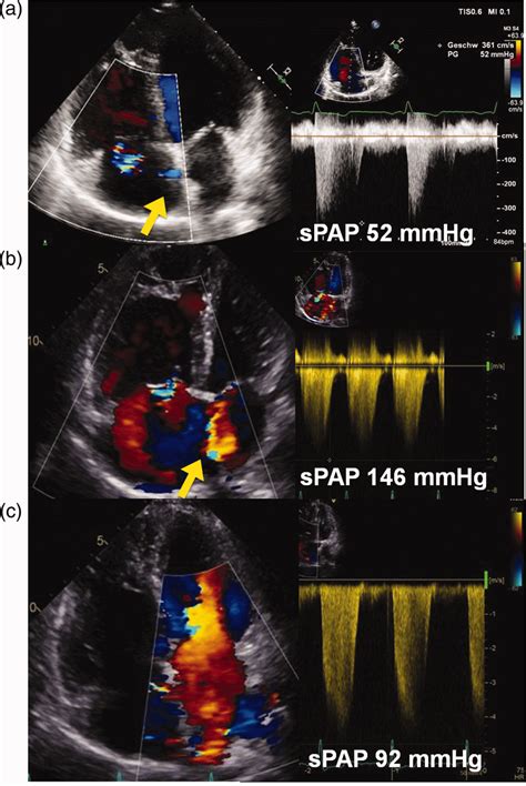 (a) Transthoracic echocardiography (TTE) before pregnancy. TTE exhibits ...