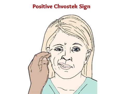 Chvostek Sign |positive Chvostek sign |causes |assessment - Nurseship.com