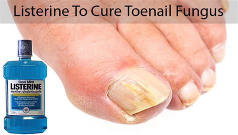 Remedies To Treat Nail Fungus Naturally - Scotland County Online