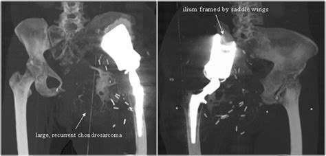 Review of hemipelvectomy endoprostheses: Indications and imaging ...