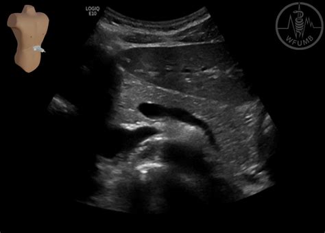 A structured systematic ultrasound examination of abdominal organs Chapter 5 Media Library – WFUMB