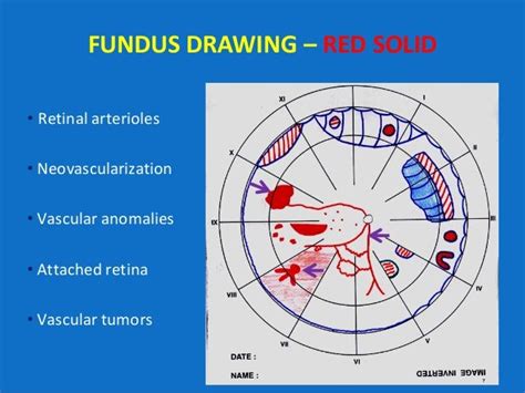 Looking deep into retina : indirect ophthalmoscopy and fundus drawing