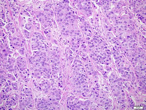 Pathology Outlines - Invasive urothelial carcinoma