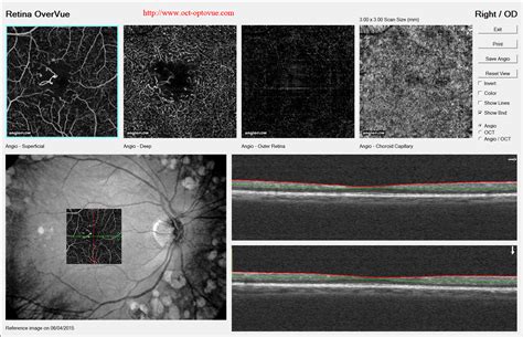 OCT angiography & DIABETES