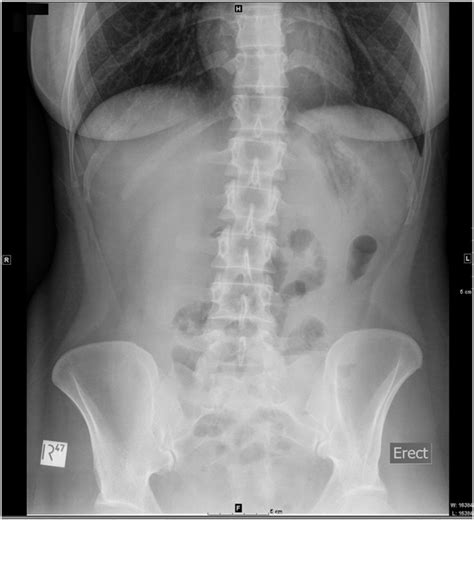 Abdominal x ray