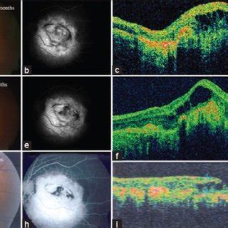 Left eye, three months post-first lucentis injection (a) Fundus ...