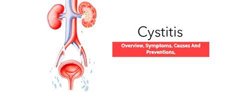 Cystitis- Overview, Symptoms, Causes and Preventions,