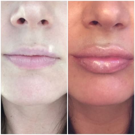 LIP INJECTIONS BEFORE AND AFTER