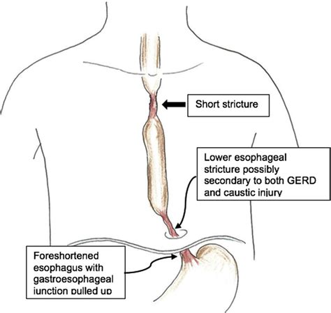 Esophageal Dilation Procedure