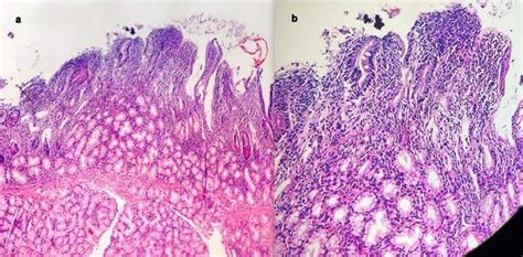 Histopathological examination: increased intraepithelial lymphocytes,... | Download Scientific ...