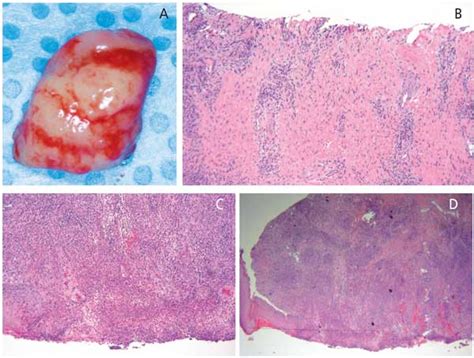 An Unusual Presentation of Peripheral Ossifying Fibroma - Decisions in ...