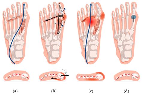 Hallux Varus Repair