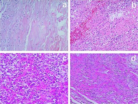 Pathological specimens of tuberculous spondylitis and pyogenic ...