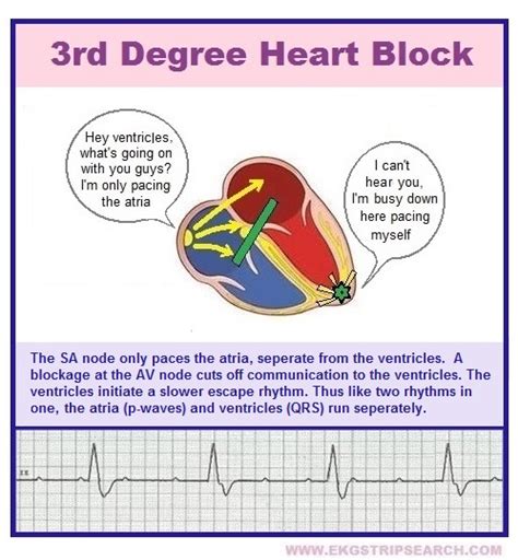 3rd Degree Heart Block; EkG STRIP SEARCH